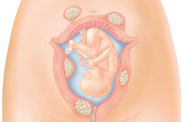 Беременность и миома матки малых размеров