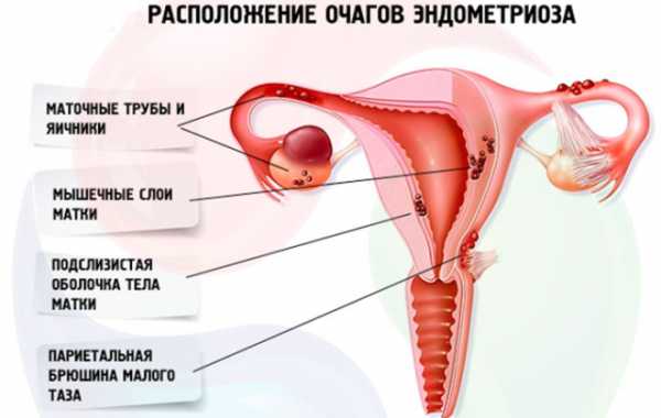 Беременность после эндометриоза