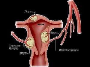 Центрипетальный рост миомы матки