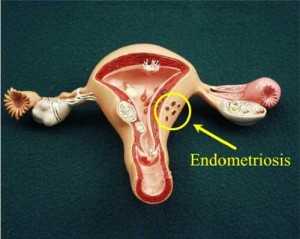 Чем лечат эндометриоз матки