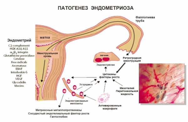 Чем опасен эндометриоз матки