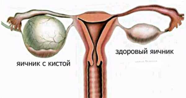 Чем опасна киста яичника у женщин
