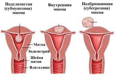Чем отличается миома от фибромы матки
