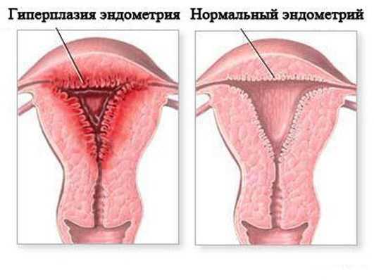 Эндометриоз гиперплазия