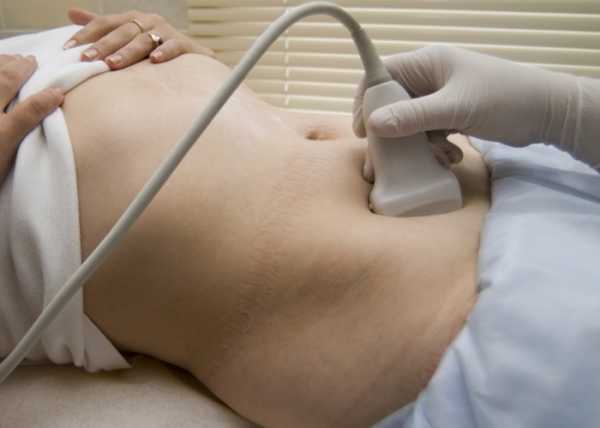 Эндометриоз и беременность можно ли забеременеть