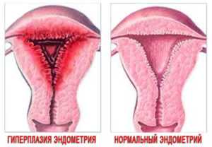 Эндометриоз и гиперплазия эндометрия в чем разница