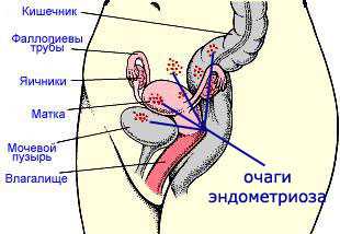 Эндометриоз кишечника