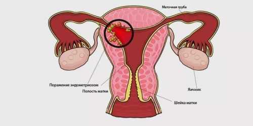 Эндометриоз матки что это такое