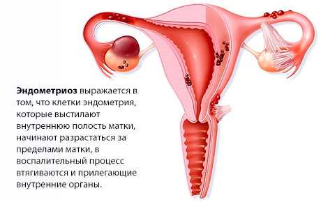 Эндометриоз мочевыводящих путей