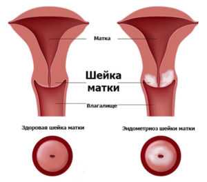 Эндометриоз шейки матки развивается после