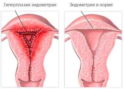 Эндометриоз в менопаузе