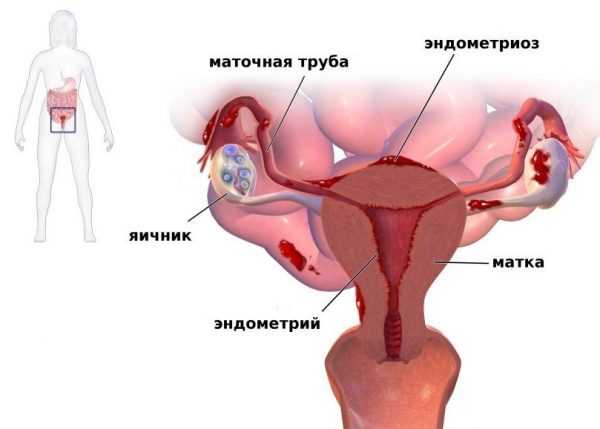 Эндометриоз во время беременности