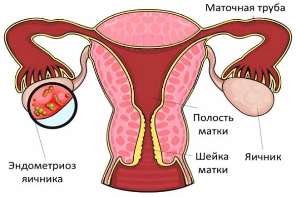 Эндометриоз яичника что это такое