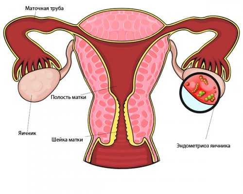 Эндометриоз яичника лечение