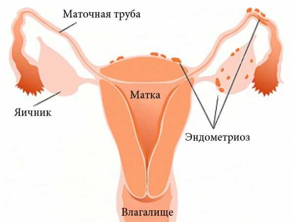 Эндометриоз задней стенки матки