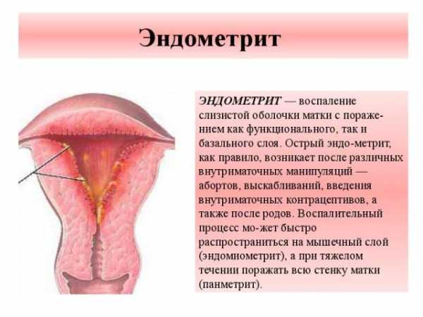Эндометрит и эндометриоз в чем разница