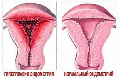 Эндометрия гиперплазия при климаксе