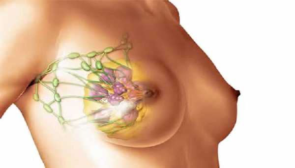 Фиброматозная мастопатия молочной железы