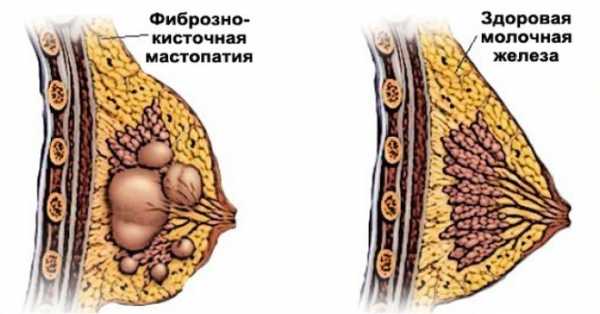 Фиброзно кистозная мастопатия с преобладанием кистозного компонента