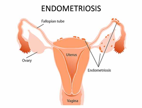 Физические нагрузки и эндометриоз