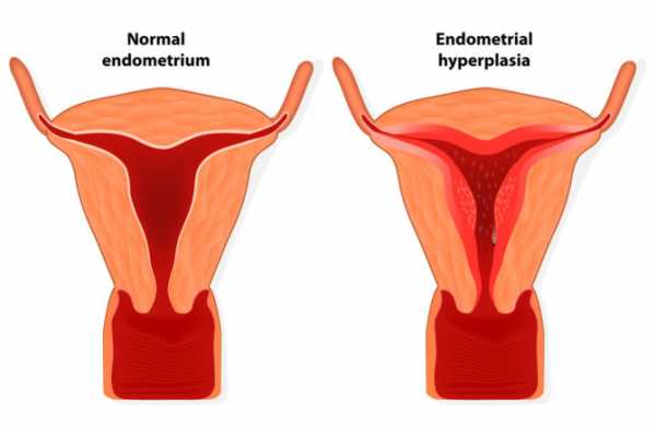 Гиперплазия эндометриоза матки