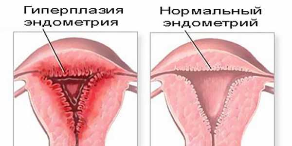 Гиперплазия эндометрия лечение при климаксе
