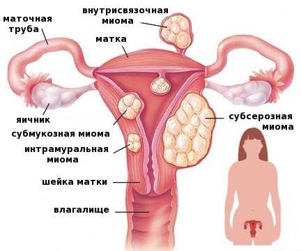 Гирудотерапия при миоме матки