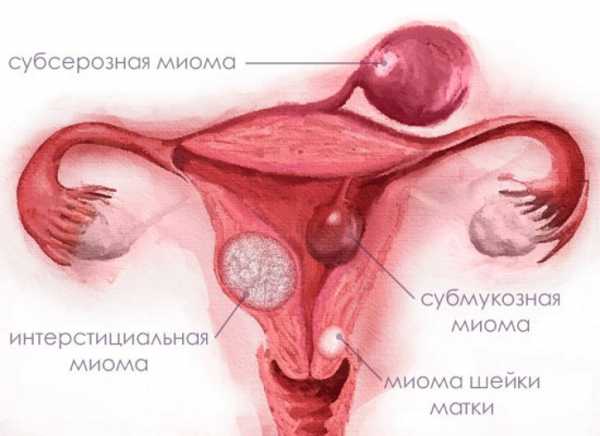 Гистерэктомия матки с миомой