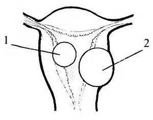 Гистероскопия матки при миоме