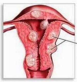Интерстициальная миома тела матки