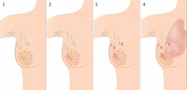 Как определить стадию рака молочной железы