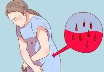 Как остановить маточное кровотечение в домашних условиях при миоме