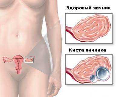 Киста яичника симптомы у женщин