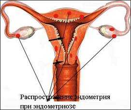 Классификация эндометриоза