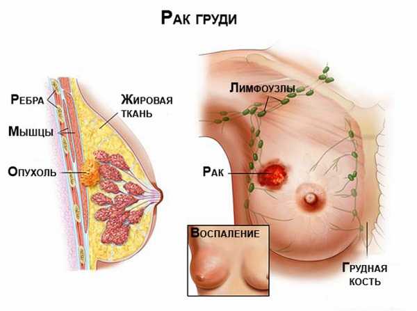 Лампэктомия молочной железы послеоперационный период
