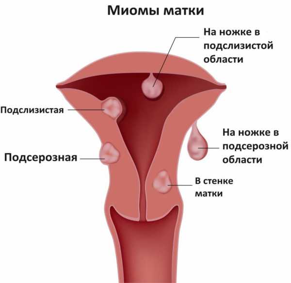 Лечение миомы матки без операции эффективно