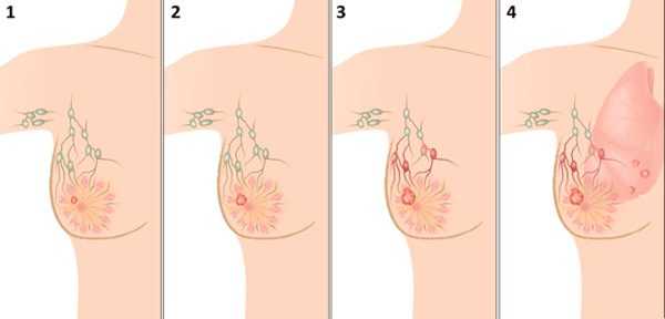 Лечение рака молочной железы 3 стадии с метастазами