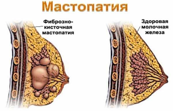 Маммопластика при мастопатии