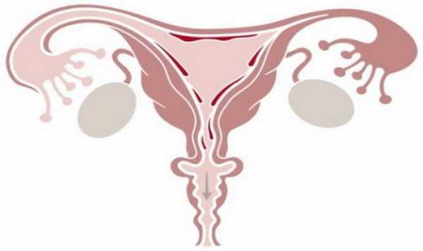 Менструация при эндометриозе