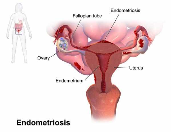 Мирена спираль при эндометриозе