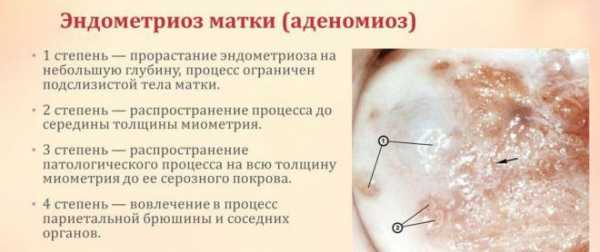 Мкб 10 эндометриоз