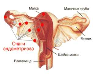 Наружный и внутренний эндометриоз