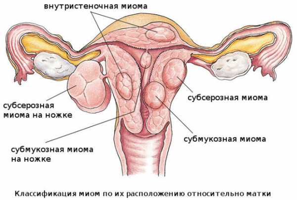 Норколут при эндометриозе