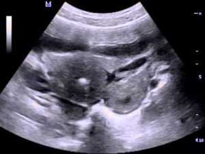 Нормальные размеры матки и яичников у нерожавших по узи