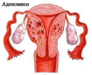 Очаговый эндометриоз матки