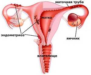 От чего возникает эндометриоз