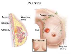 Первая стадия рака молочной железы