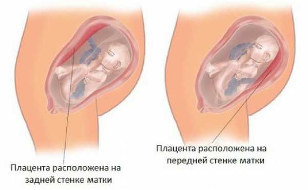 Плацента и миома по передней стенке