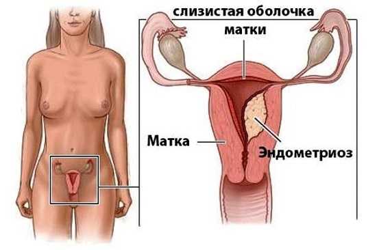 Последствия эндометриоз матки