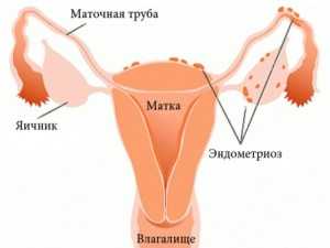 Препараты для лечения эндометриоза у женщин
